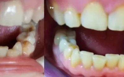 Referencia: Extrakcia zuba – Ako sa jej vyhnúť pomocou dentozofie?